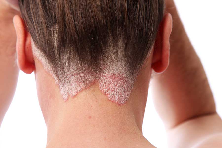 Psoriasis Skin Disease on Backhead
